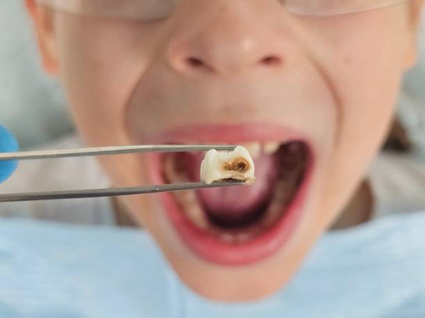 Best Emergency Dental Care for Broken or Chipped Teeth in Falling Waters, WV