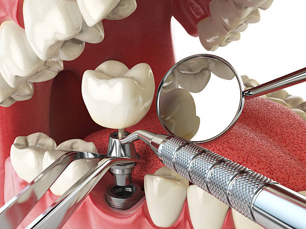 Best Emergency Treatment for Dental Infections or Abscesses in Falling Waters, WV